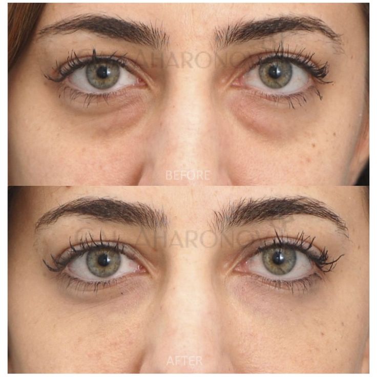 EyeLift Pro – Adiós ojeras y bolsas en 2 minutos