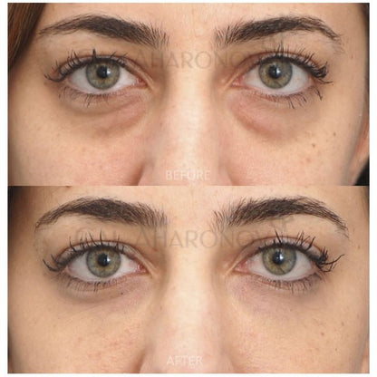 EyeLift Pro – Adiós ojeras y bolsas en 2 minutos